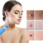 Skin Tag Removal Kit – Painless Micro-Compression Technology