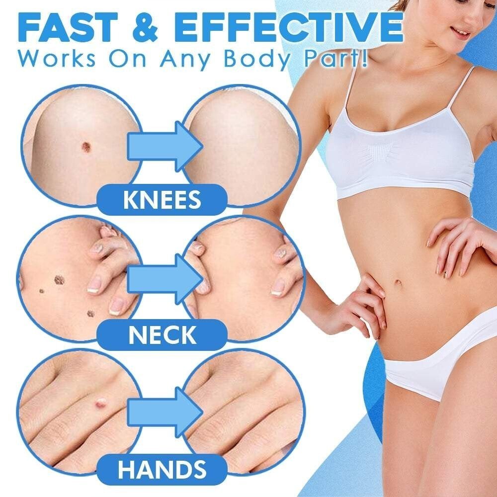 Hautfibrom-Entfernungsset mit Ligaturband