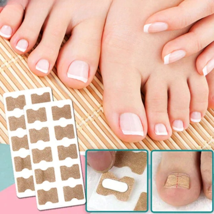 Nail patch for correcting ingrown nails