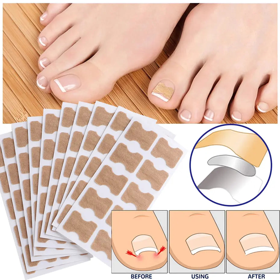 Nail patch for correcting ingrown nails