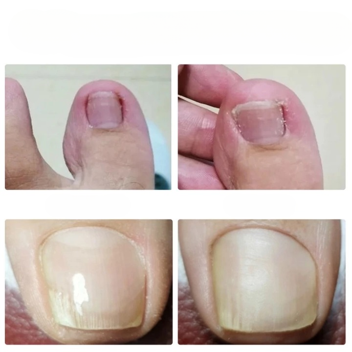 Nail patch for correcting ingrown nails