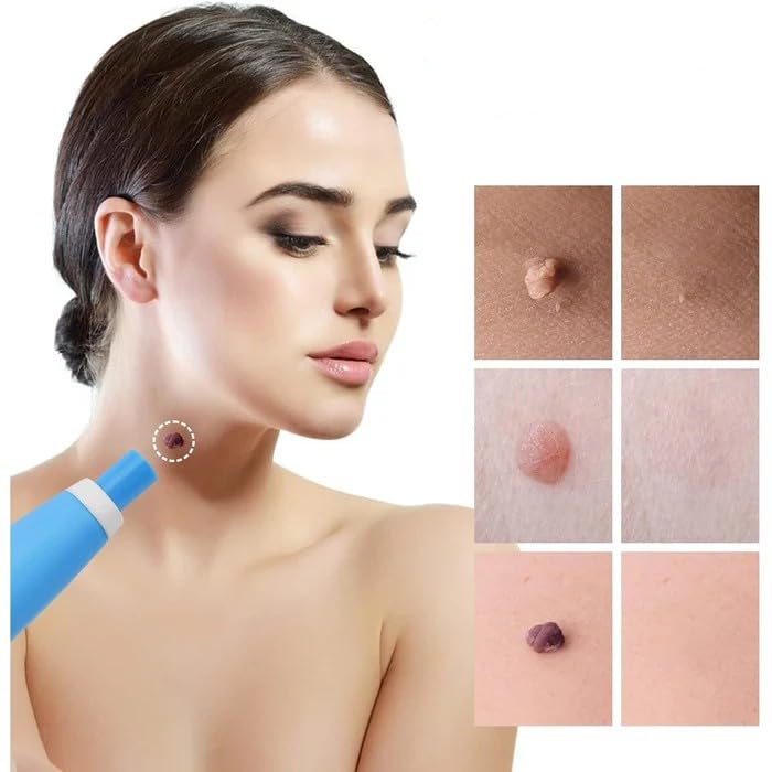 Skin Tag Removal Kit – Painless Micro-Compression Technology
