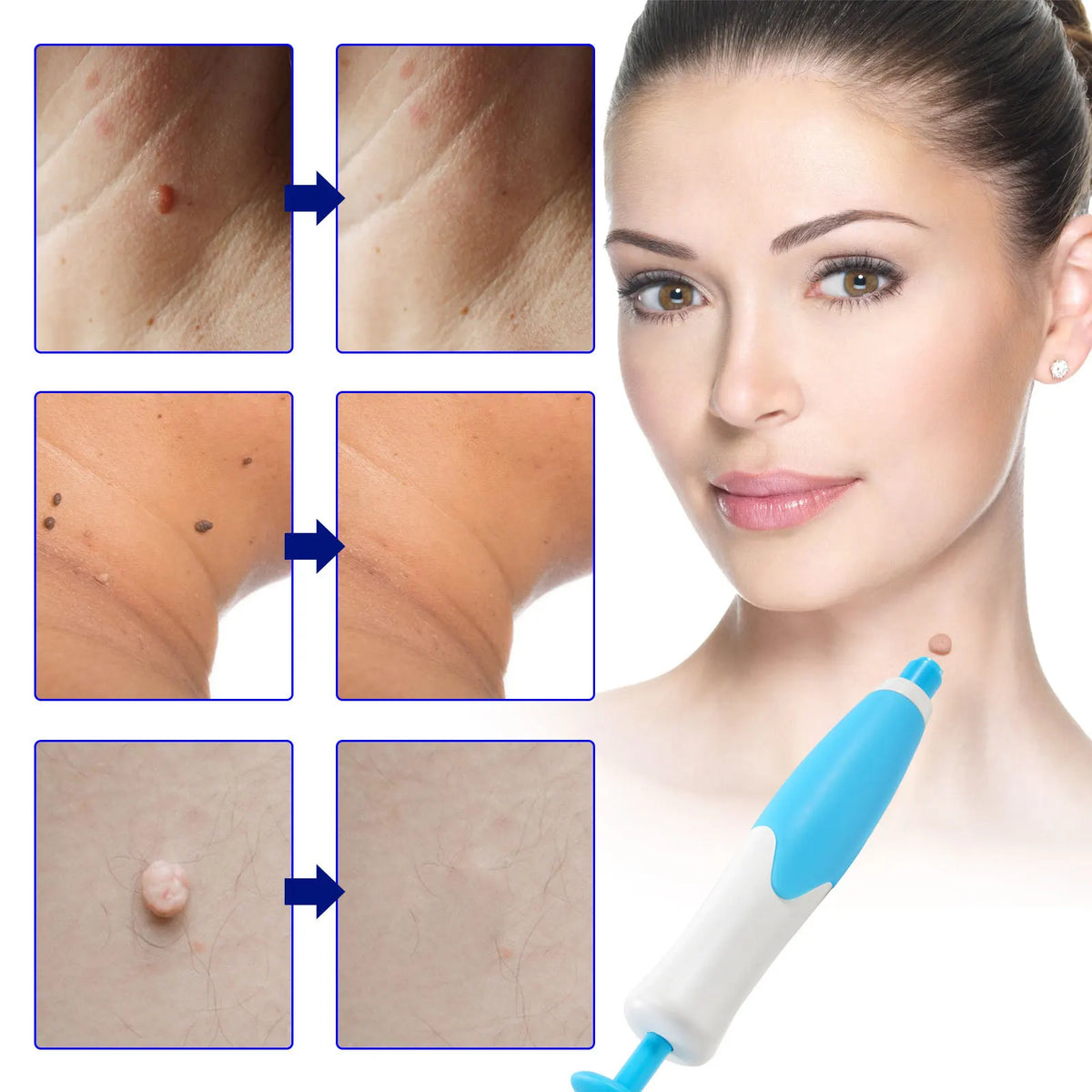 Skin Tag Removal Kit – Painless Micro-Compression Technology