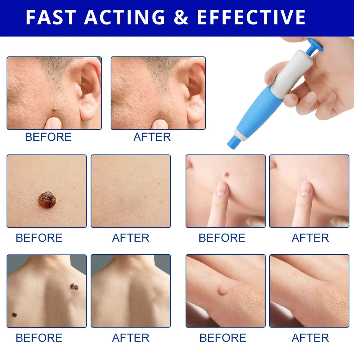 Skin Tag Removal Kit – Painless Micro-Compression Technology