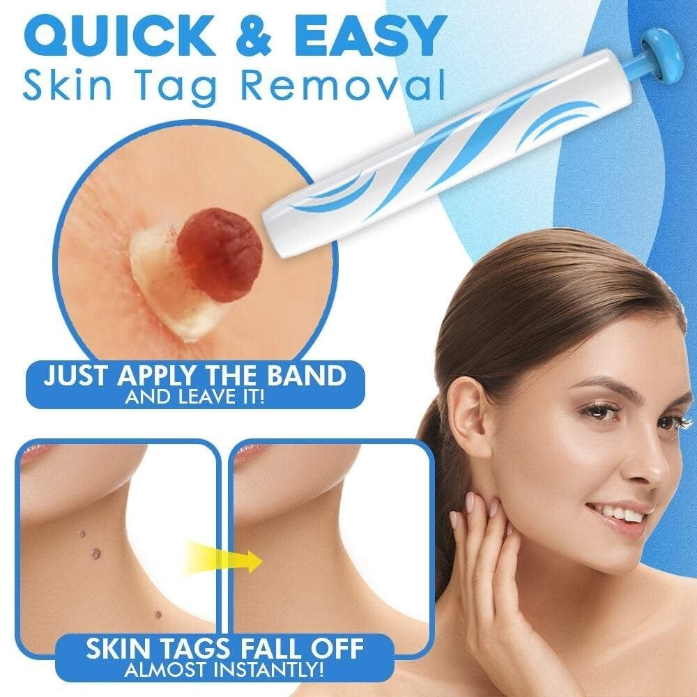 Hautfibrom-Entfernungsset mit Ligaturband