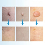 Skin Tag Removal Kit – Painless Micro-Compression Technology